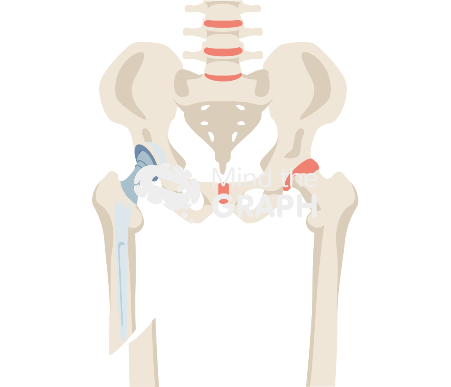 Total hip arthroplasty periprosthetic fracture bone full Icons, Symbols, Pictures, and Images