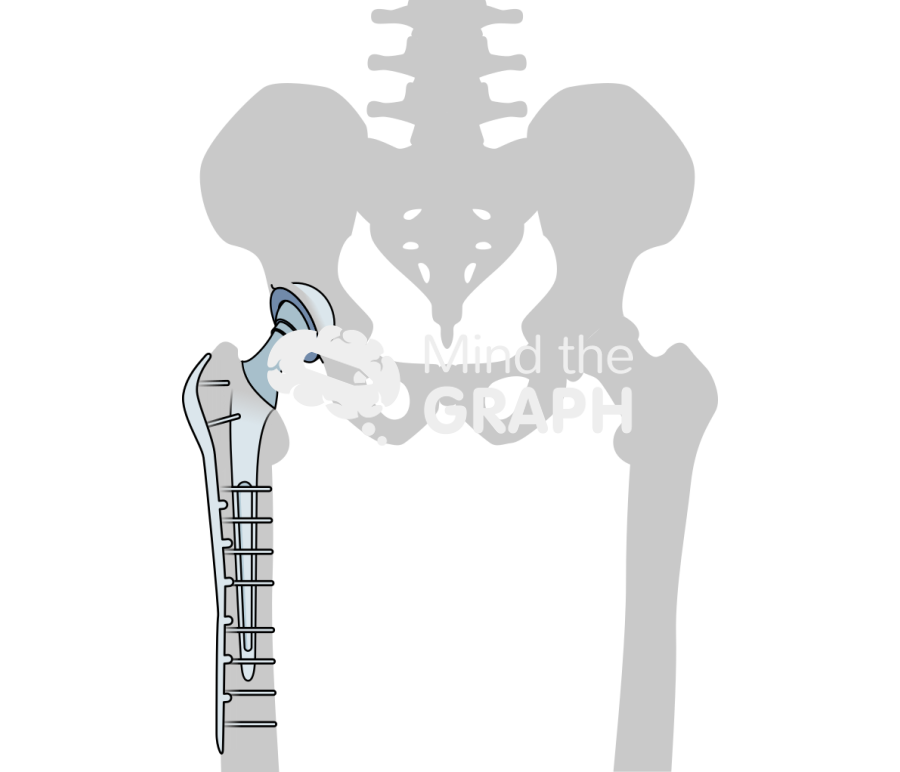 Total hip arthroplasty periprosthetic fracture plating bone Icons, Symbols, Pictures, and Images