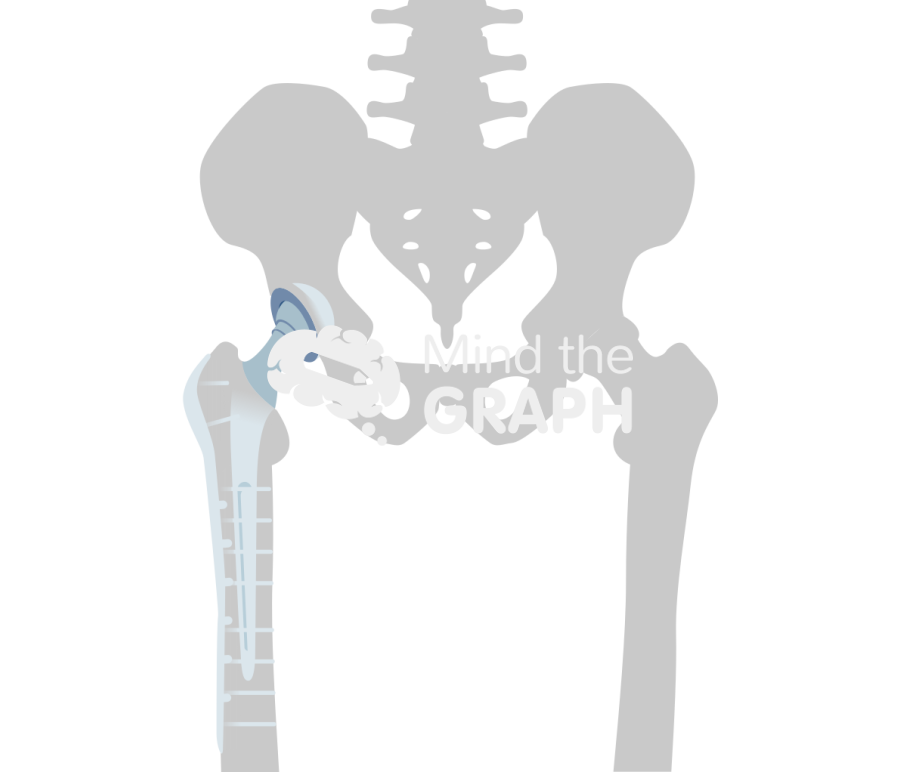 Total hip arthroplasty periprosthetic fracture plating bone Icons, Symbols, Pictures, and Images