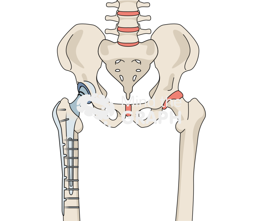 Total hip arthroplasty periprosthetic fracture plating full Icons, Symbols, Pictures, and Images