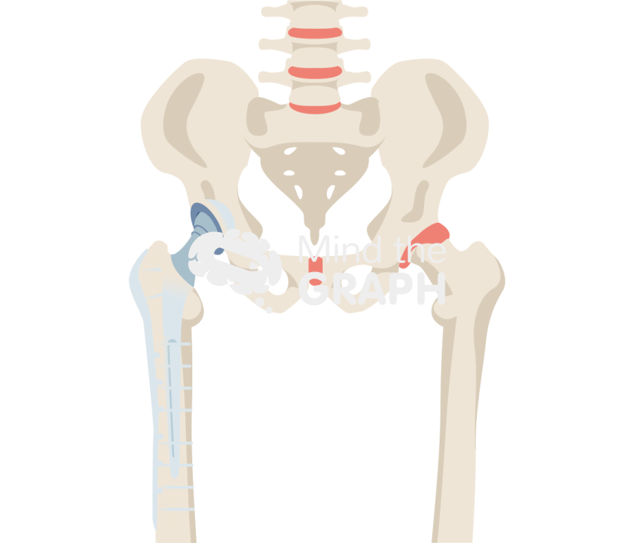 Total hip arthroplasty periprosthetic fracture plating full Icons, Symbols, Pictures, and Images