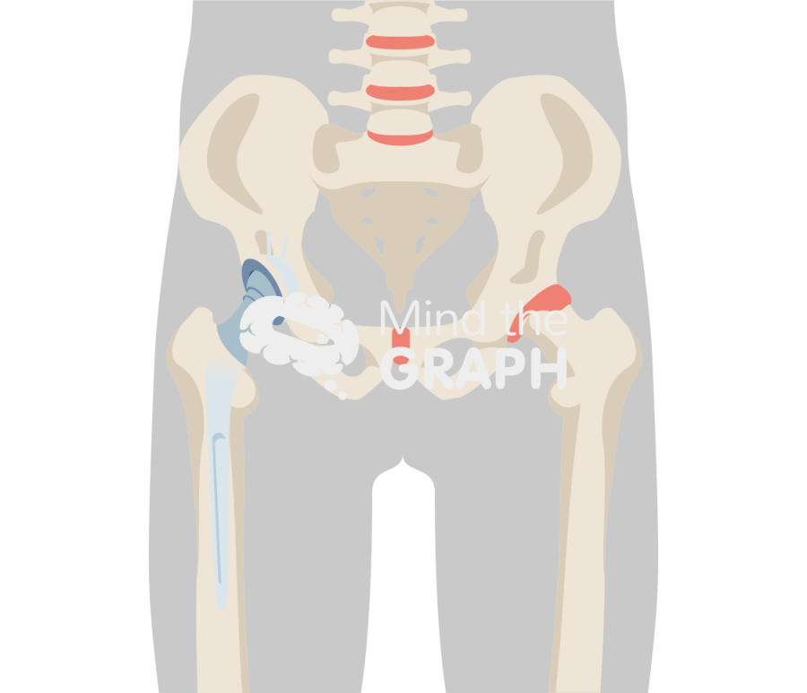 Total hip replacement revision body Icons, Symbols, Pictures, and Images