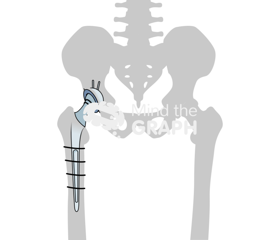 Total hip replacement revision bone Icons, Symbols, Pictures, and Images