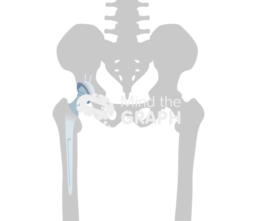 Total hip replacement revision bone Icons, Symbols, Pictures, and Images