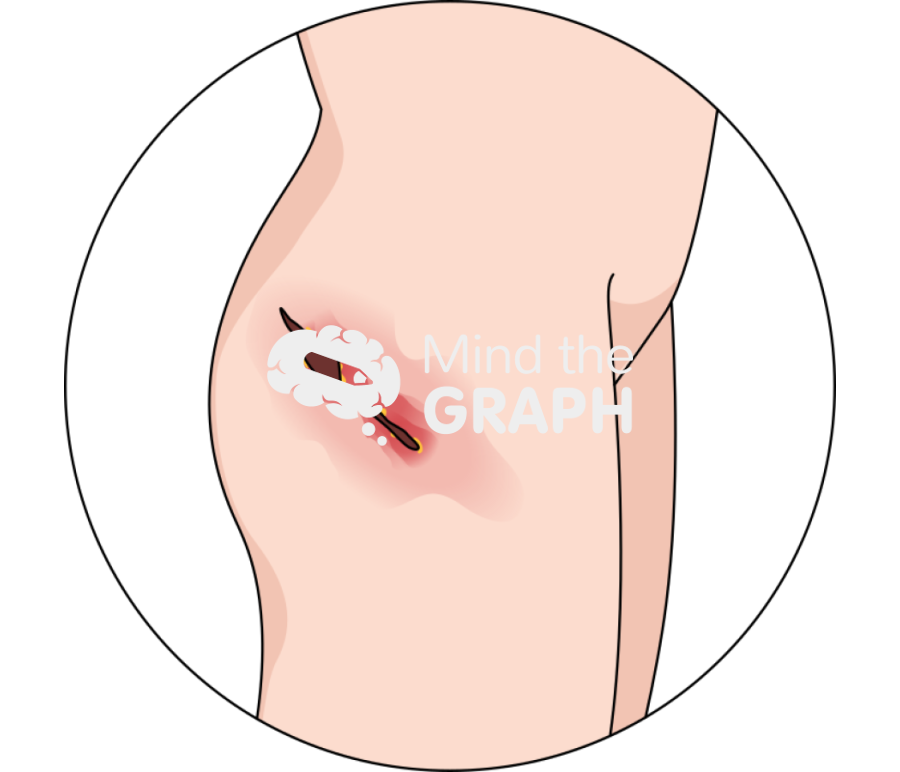 Total hip replacement tha infection body zoom Icons, Symbols, Pictures, and Images