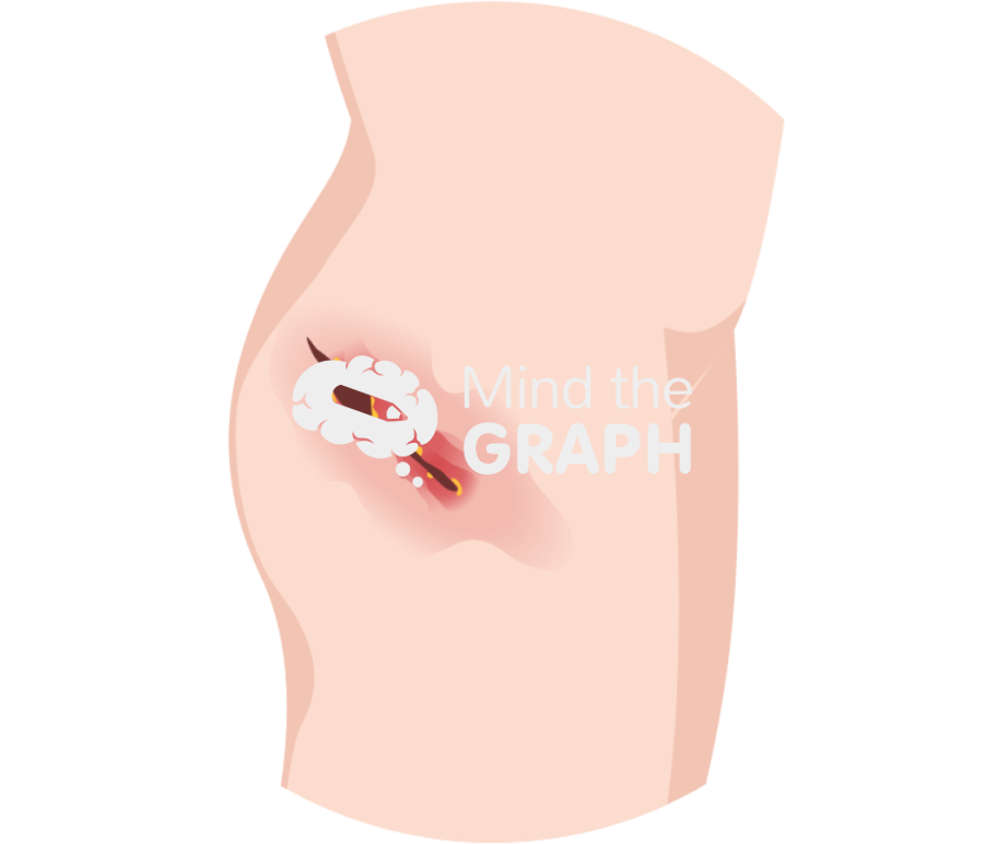 Total hip replacement tha infection body zoom Icons, Symbols, Pictures, and Images
