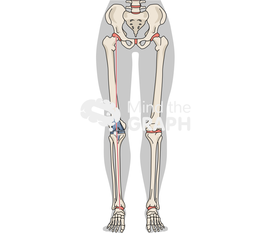 Total knee arthroplasty alignment body Icons, Symbols, Pictures, and Images