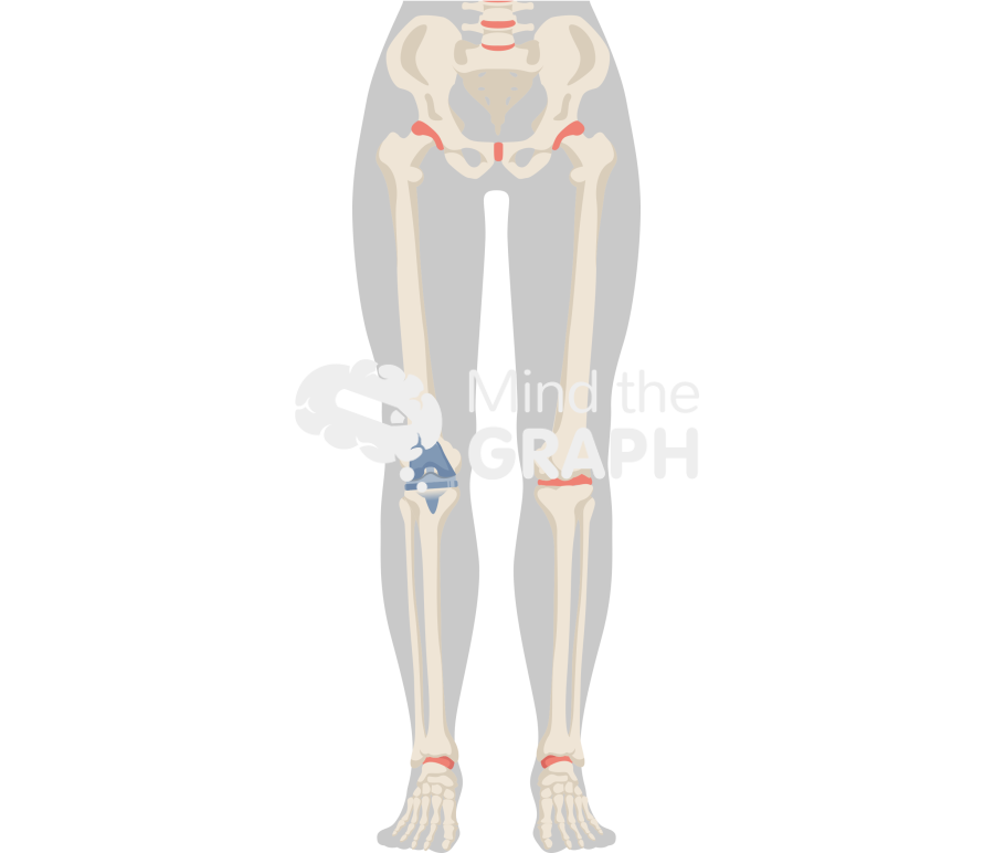 Total knee arthroplasty alignment body Icons, Symbols, Pictures, and Images