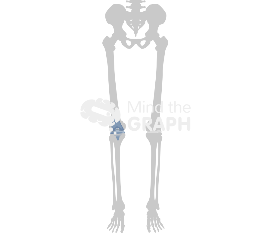 Total knee arthroplasty alignment bone Icons, Symbols, Pictures, and Images