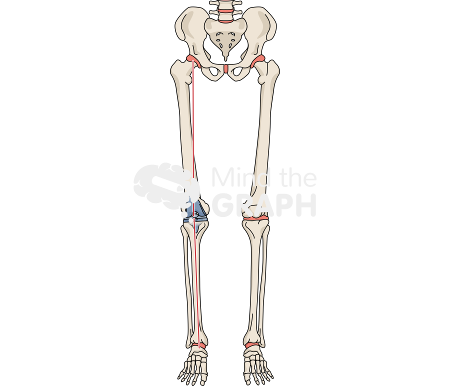 Total knee arthroplasty alignment bone full Icons, Symbols, Pictures, and Images