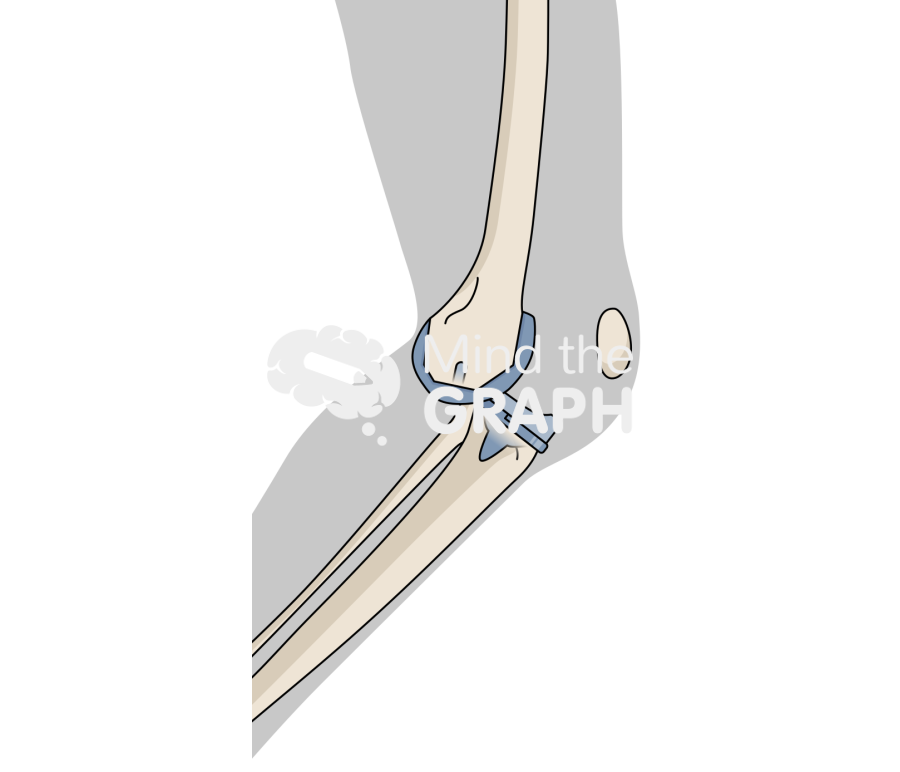 Total knee arthroplasty back dislocation body Icons, Symbols, Pictures, and Images