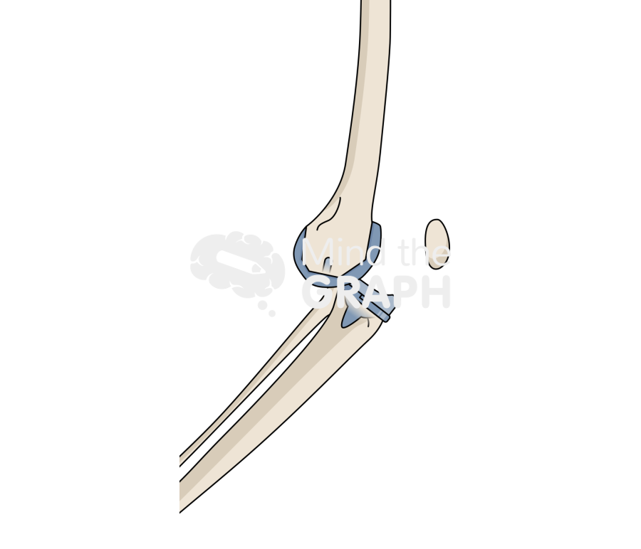 Total knee arthroplasty back dislocation bone full Icons, Symbols, Pictures, and Images