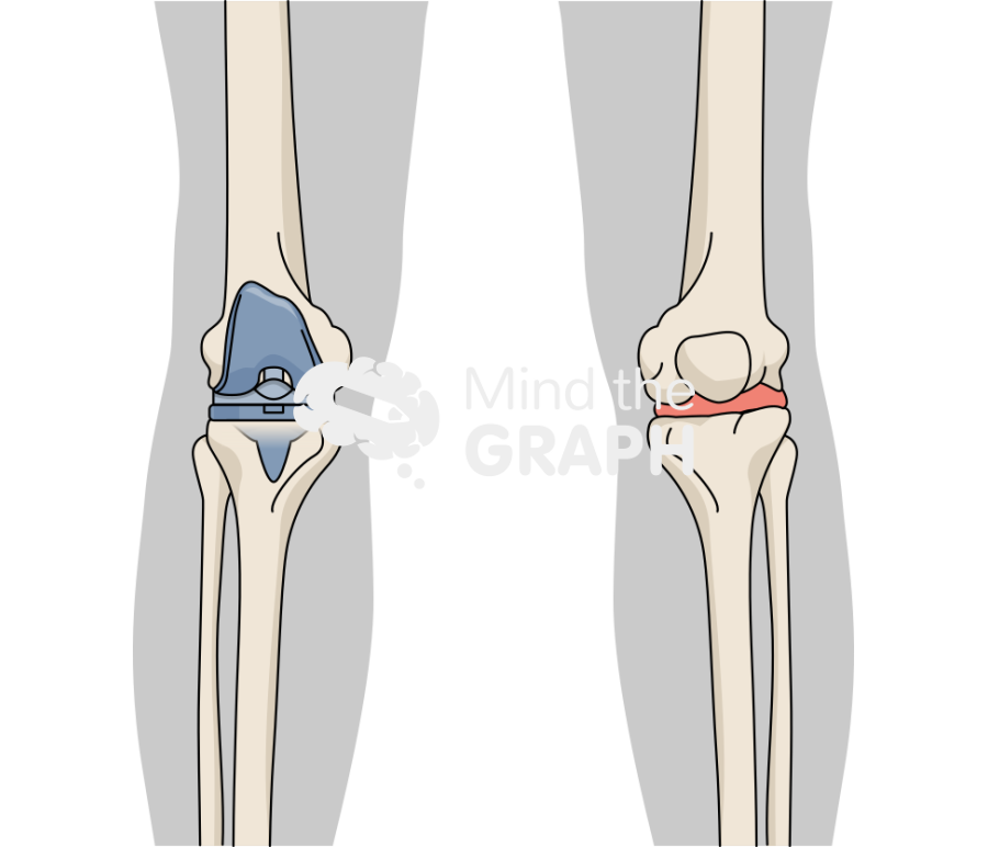 Total knee arthroplasty body Icons, Symbols, Pictures, and Images