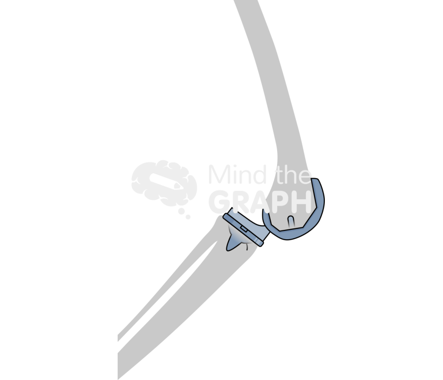 Total knee arthroplasty dislocation bone Icons, Symbols, Pictures, and Images