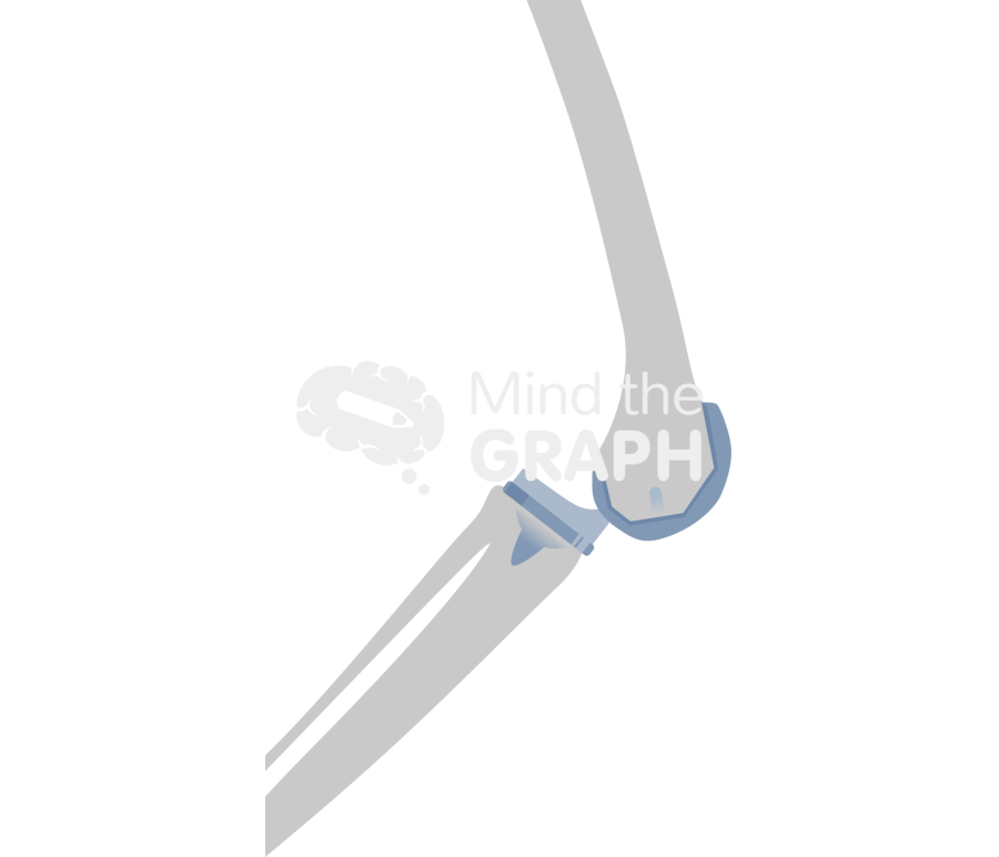 Total knee arthroplasty dislocation bone Icons, Symbols, Pictures, and Images