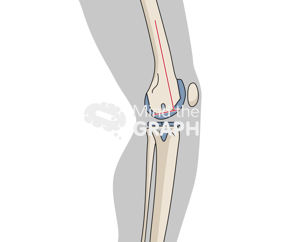 Total knee arthroplasty flexion angle body Icons, Symbols, Pictures, and Images