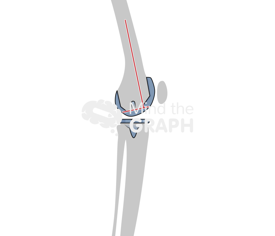 Total knee arthroplasty flexion angle bone Icons, Symbols, Pictures, and Images
