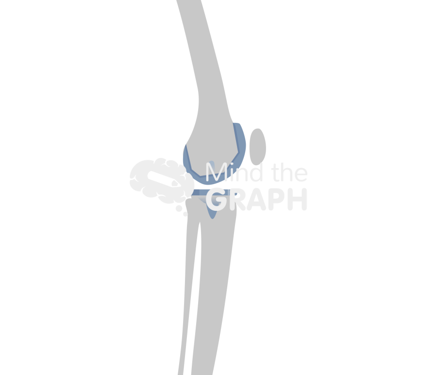 Total knee arthroplasty flexion angle bone Icons, Symbols, Pictures, and Images