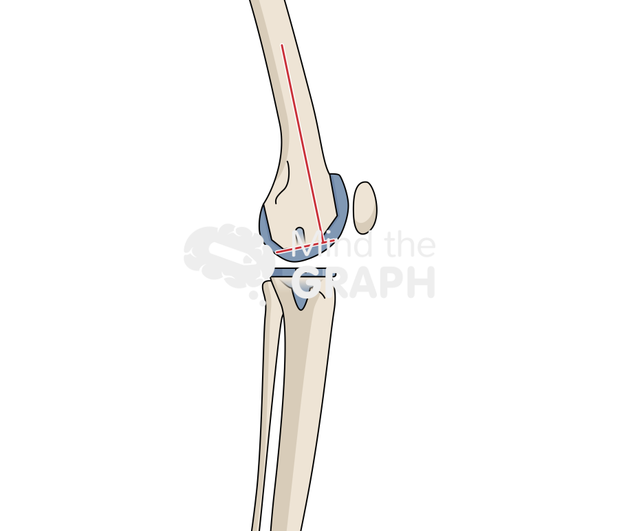 Total knee arthroplasty flexion angle bone full Icons, Symbols, Pictures, and Images