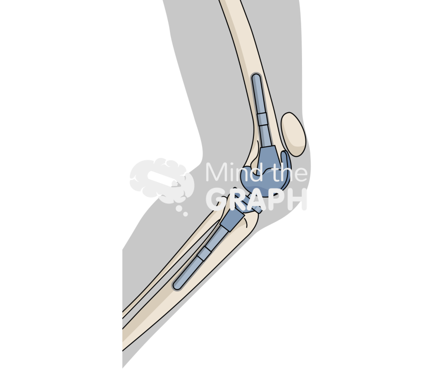 Total knee arthroplasty patella tendon rupture Icons, Symbols, Pictures, and Images