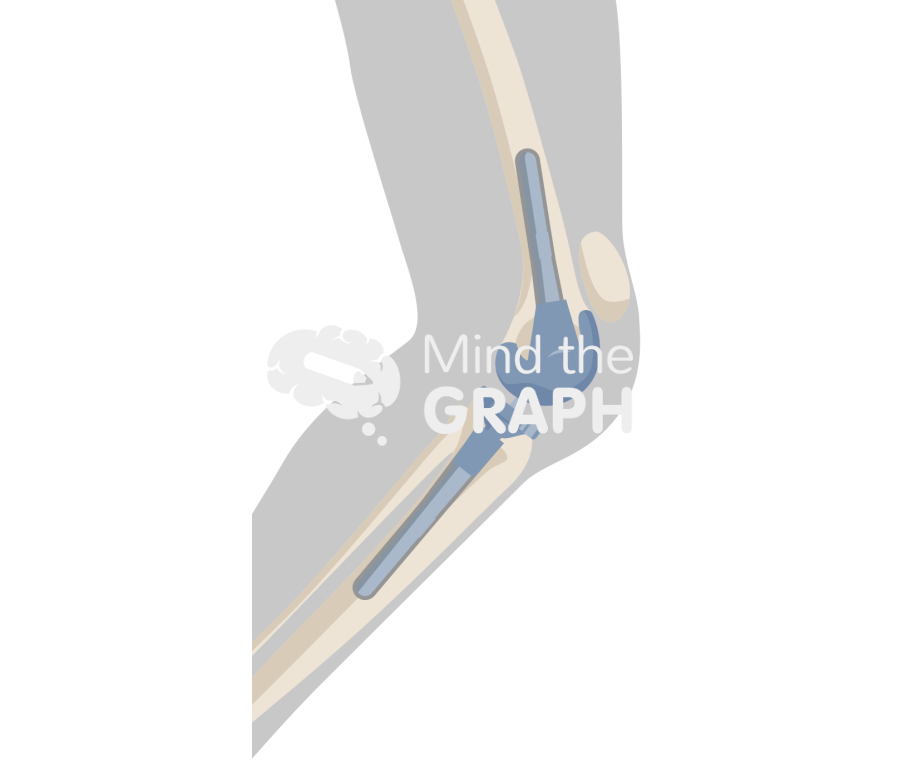Total knee arthroplasty patella tendon rupture Icons, Symbols, Pictures, and Images