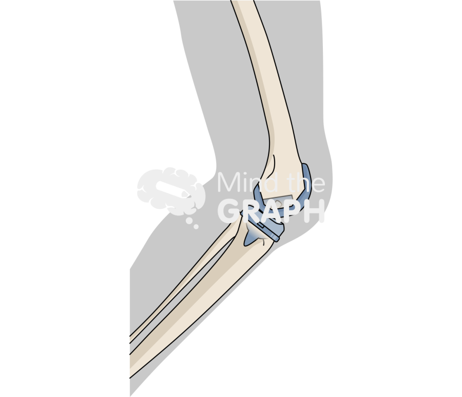 Total knee arthroplasty posterior stabilized body Icons, Symbols, Pictures, and Images