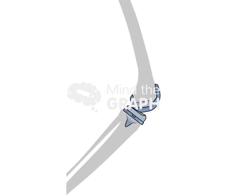 Total knee arthroplasty posterior stabilized bone Icons, Symbols, Pictures, and Images