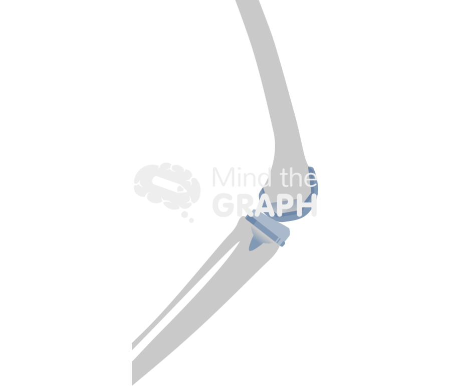 Total knee arthroplasty posterior stabilized bone Icons, Symbols, Pictures, and Images