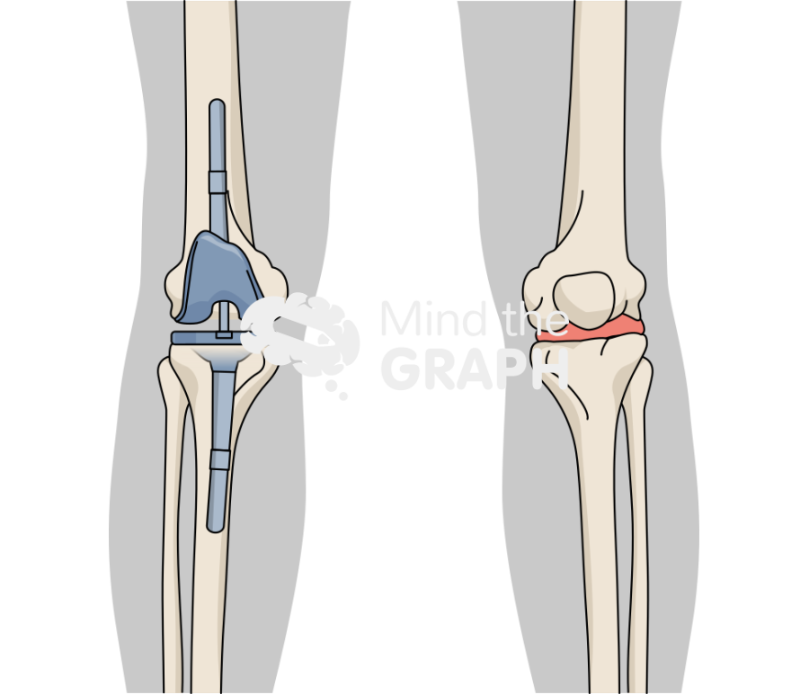 Total knee arthroplasty revision approach body Icons, Symbols, Pictures, and Images