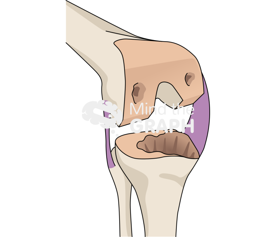 Total knee arthroplasty revision bone loss2 Icons, Symbols, Pictures, and Images