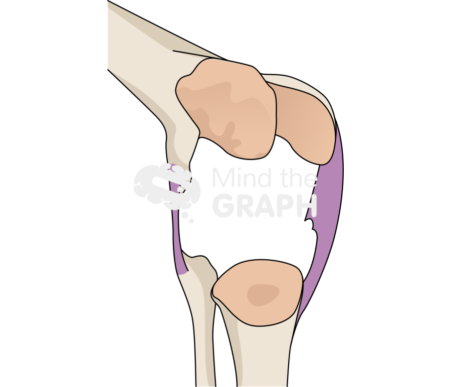 Total knee arthroplasty revision bone loss4 Icons, Symbols, Pictures, and Images