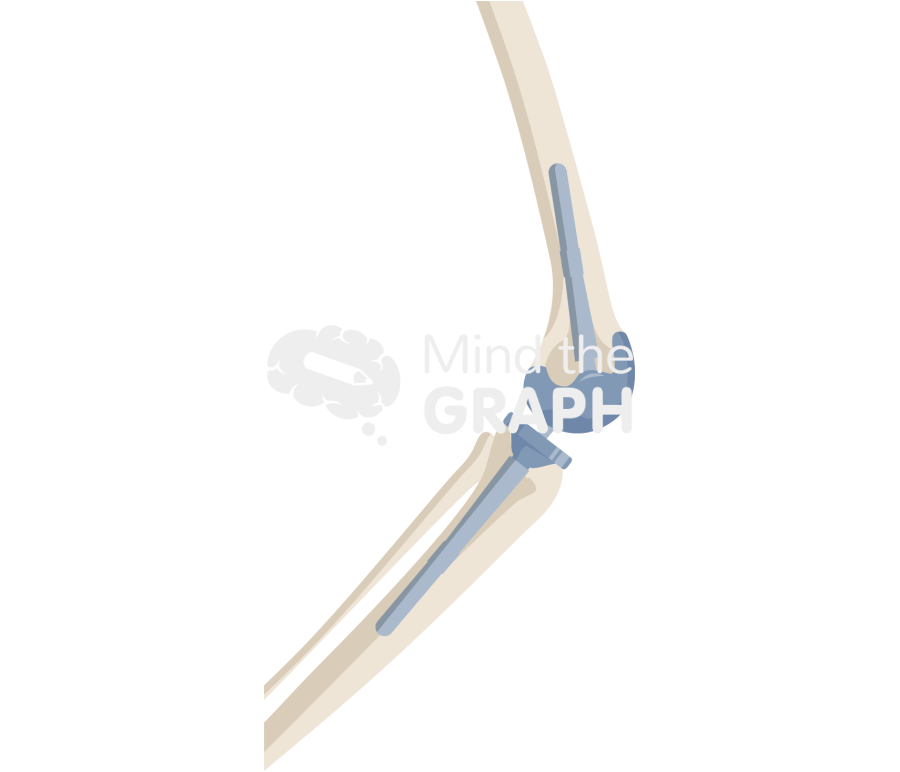 Total knee arthroplasty revision lateral bone full Icons, Symbols, Pictures, and Images