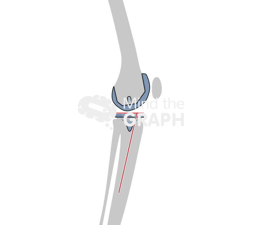 Total knee arthroplasty tibial slope bone Icons, Symbols, Pictures, and Images