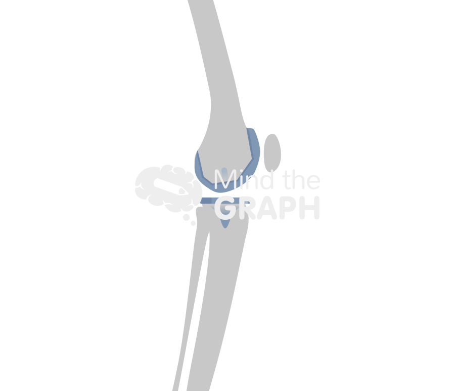 Total knee arthroplasty tibial slope bone Icons, Symbols, Pictures, and Images