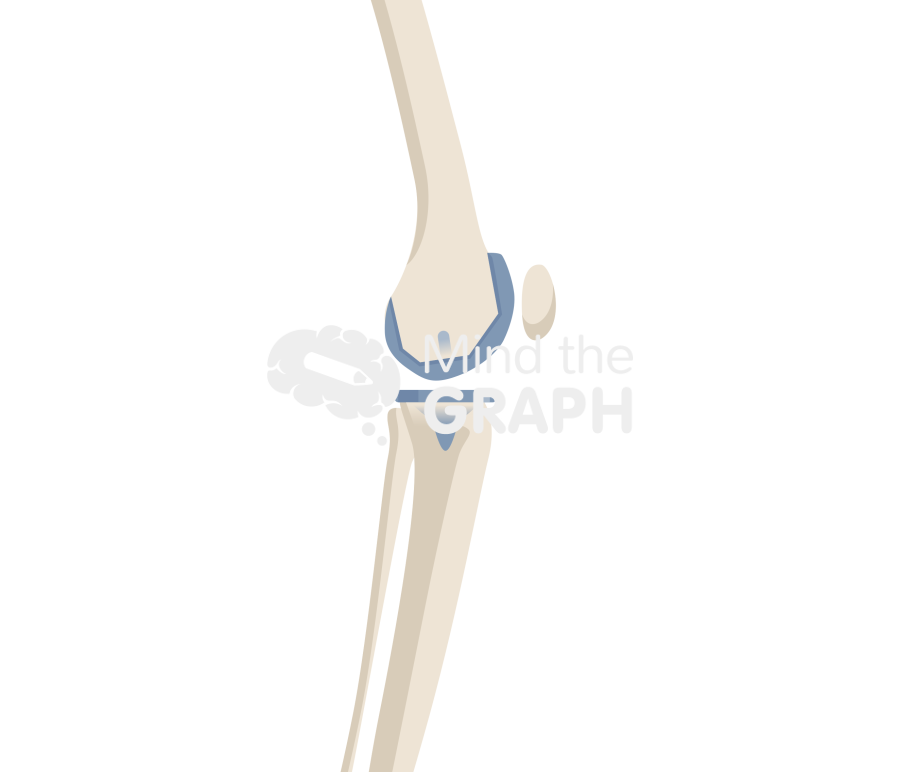 Total knee arthroplasty tibial slope bone full Icons, Symbols, Pictures, and Images