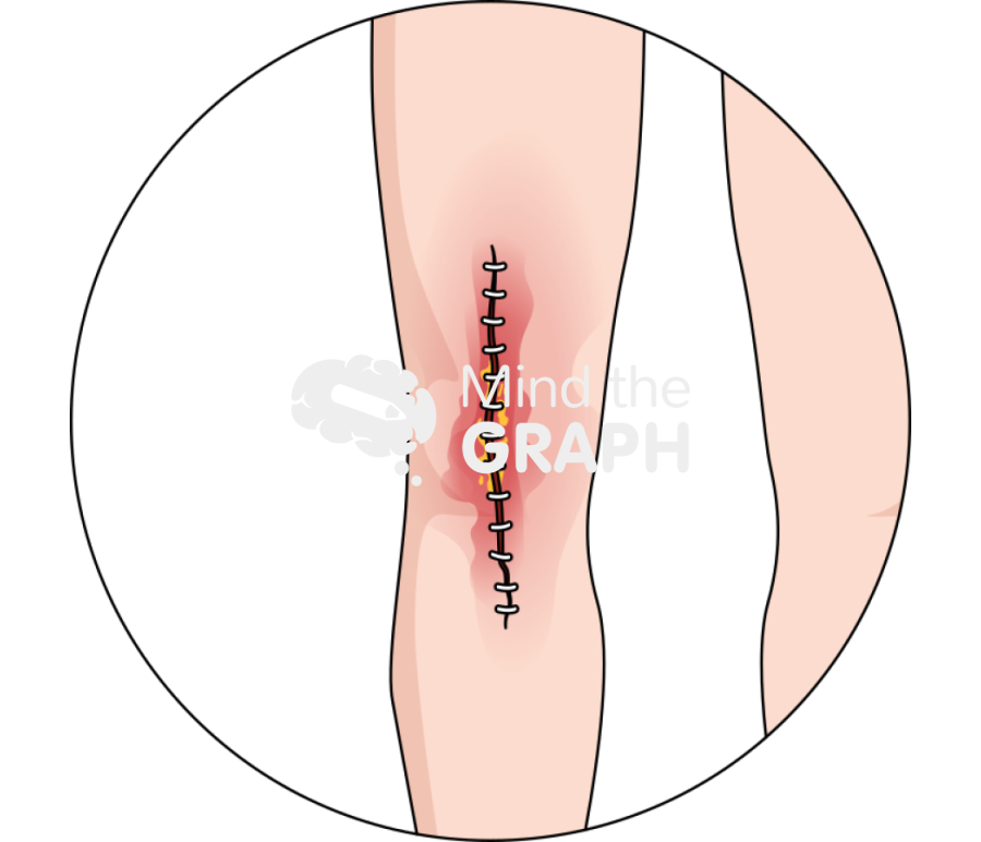 Total knee arthroplasty tka infection body zoom Icons, Symbols, Pictures, and Images