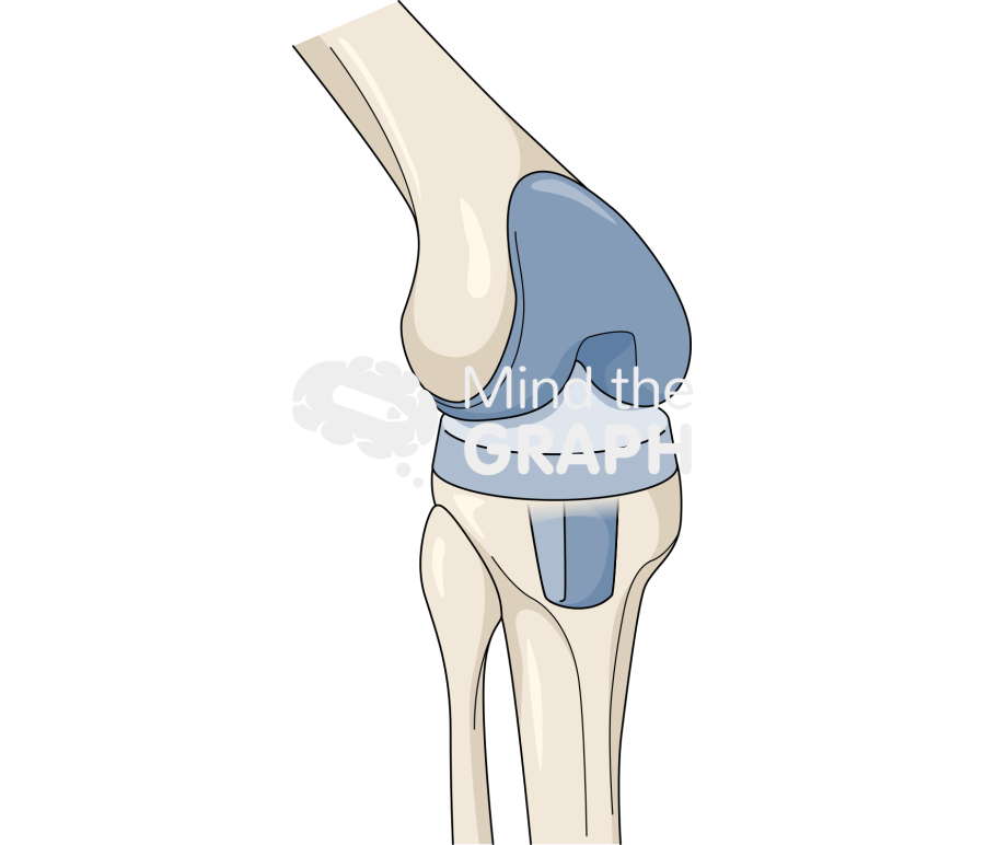 Total knee replacement bone full Icons, Symbols, Pictures, and Images