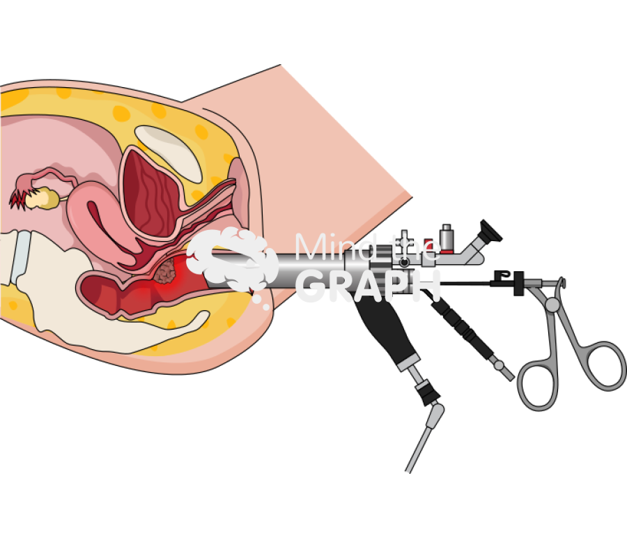 Transanal endoscopic cancer female longitudinal cut Icons, Symbols, Pictures, and Images