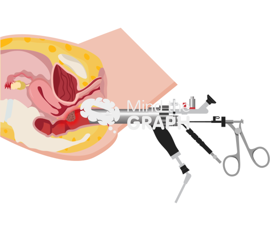 Transanal endoscopic cancer female longitudinal cut Icons, Symbols, Pictures, and Images