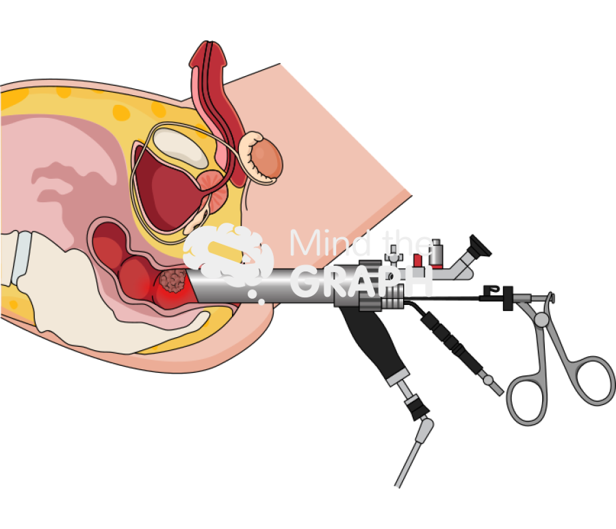Transanal endoscopic cancer male longitudinal cut Icons, Symbols, Pictures, and Images