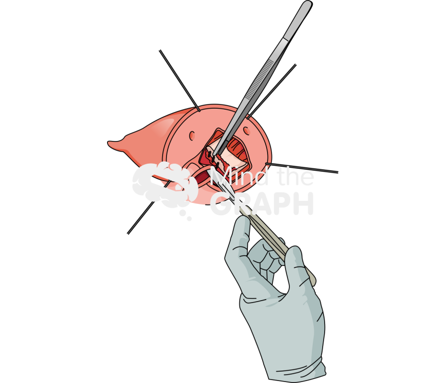 Transcatheter aortic valve explant commando reconstruction intervalvular fibrous body procedure 1 Icons, Symbols, Pictures, and Images