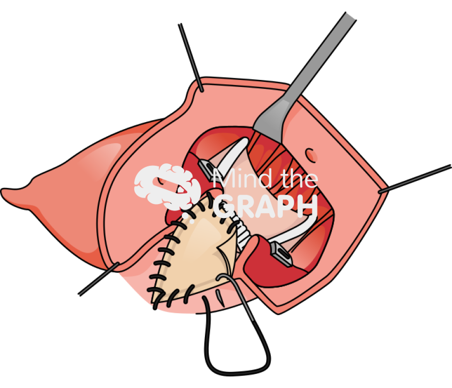 Transcatheter aortic valve explant commando reconstruction intervalvular fibrous body procedure 4 Icons, Symbols, Pictures, and Images