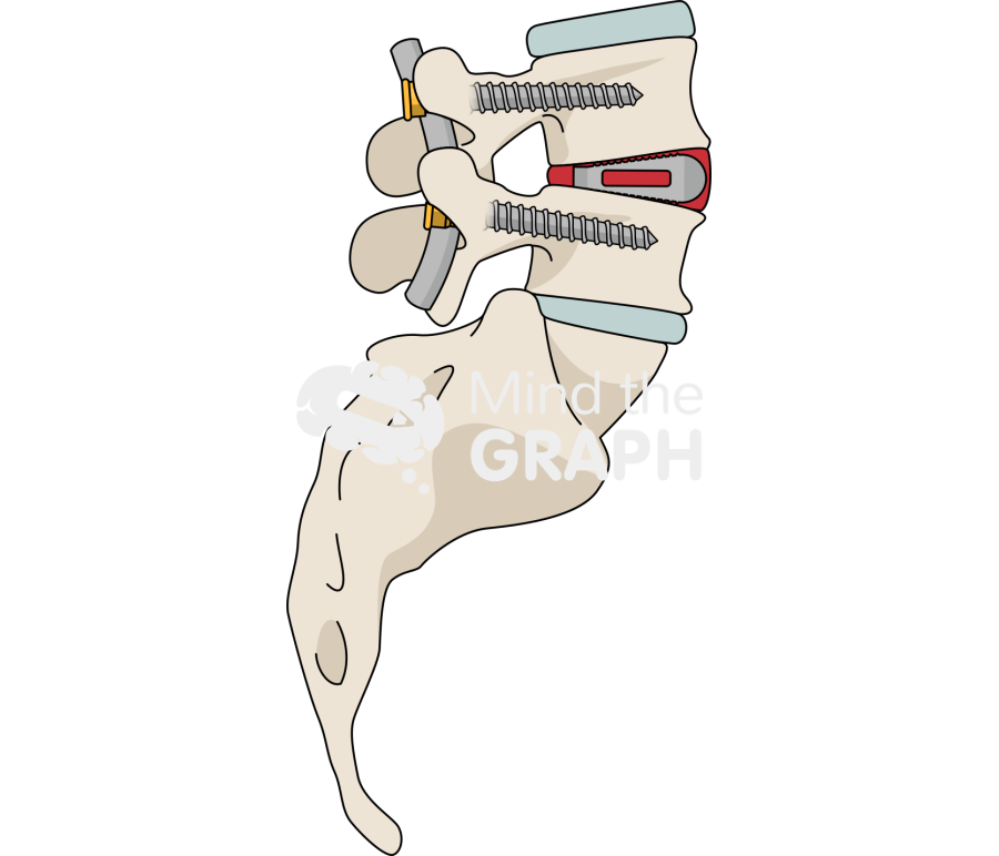 Transformainal interbody fusion Icons, Symbols, Pictures, and Images