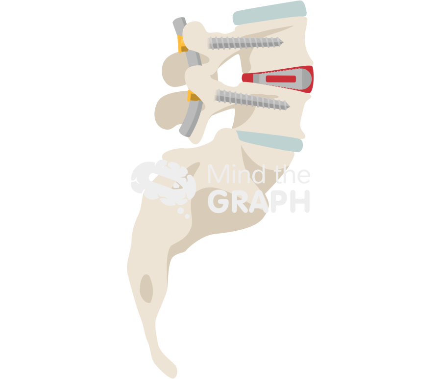 Transformainal interbody fusion Icons, Symbols, Pictures, and Images