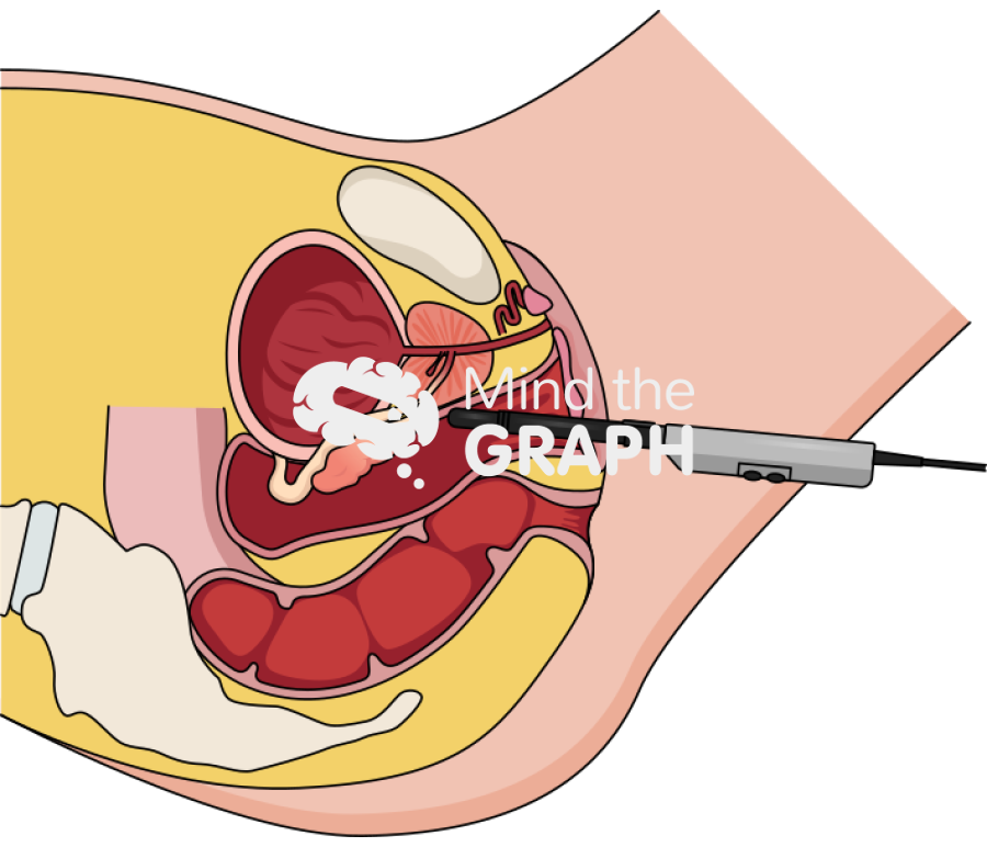 Transvaginal prostate ultrasound neovagina Icons, Symbols, Pictures, and Images