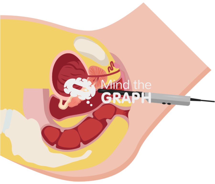 Transvaginal prostate ultrasound neovagina Icons, Symbols, Pictures, and Images