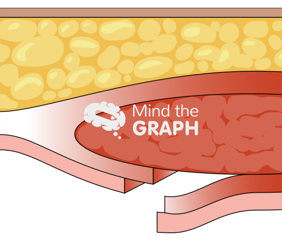 Transversus abdominis release hernia repair Icons, Symbols, Pictures, and Images