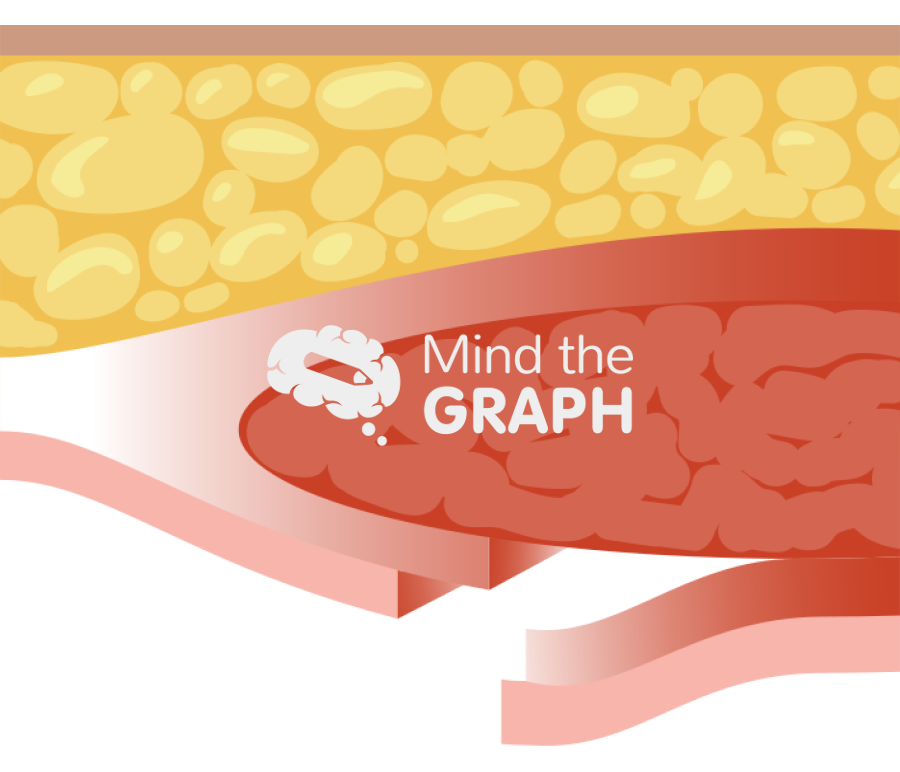 Transversus abdominis release hernia repair Icons, Symbols, Pictures, and Images