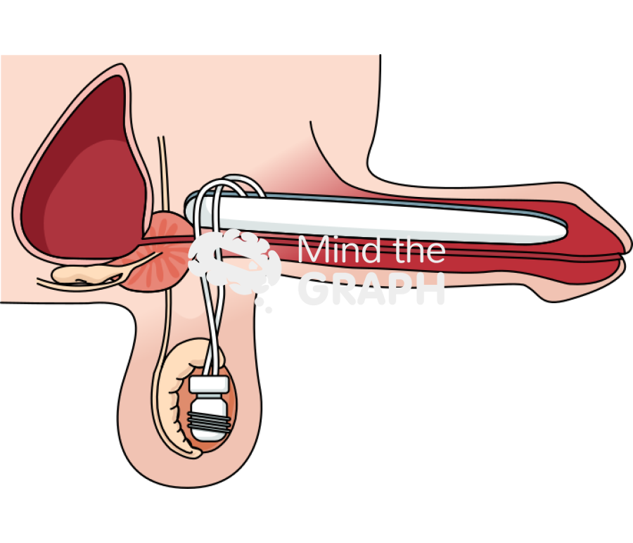 Two piece inflatable penile implant erect Icons, Symbols, Pictures, and Images