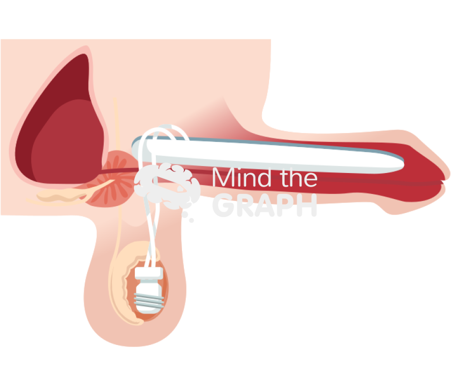 Two piece inflatable penile implant erect Icons, Symbols, Pictures, and Images